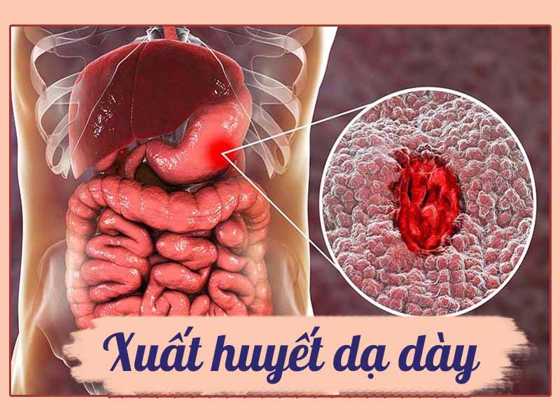 Xuất huyết dạ dày là gì? Cách điều trị, xử lý, chăm sóc khi bị xuất huyết