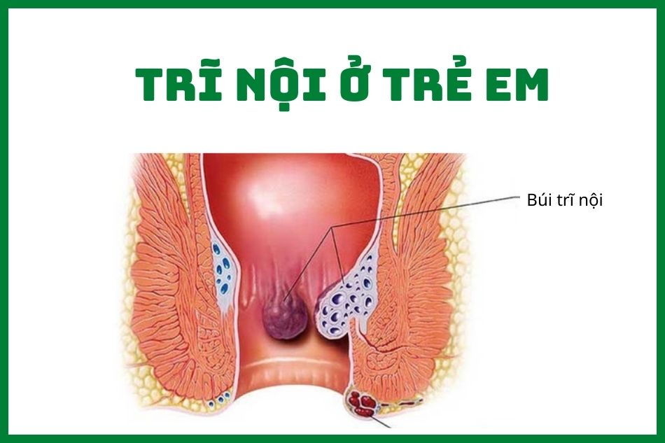 Bệnh trĩ ở trẻ em - Cách điều trị và phòng tránh hiệu quả